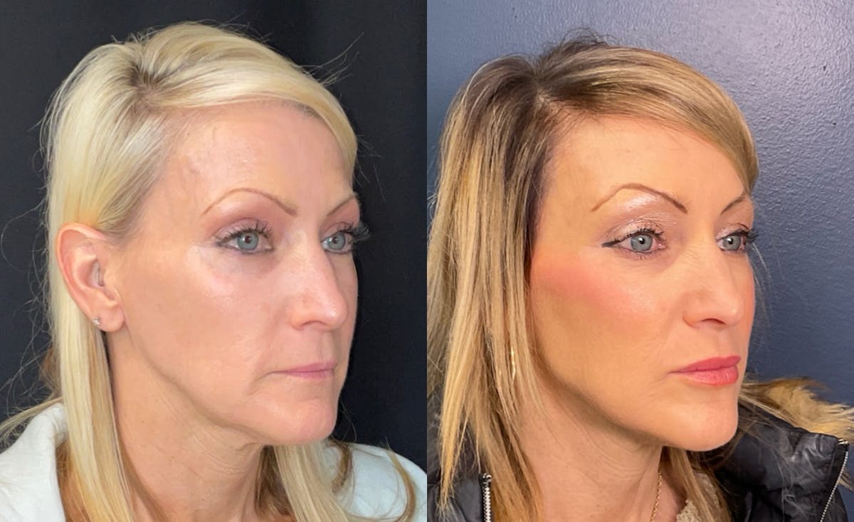 Sculptra Before & After Gallery - Patient 455043 - Image 2