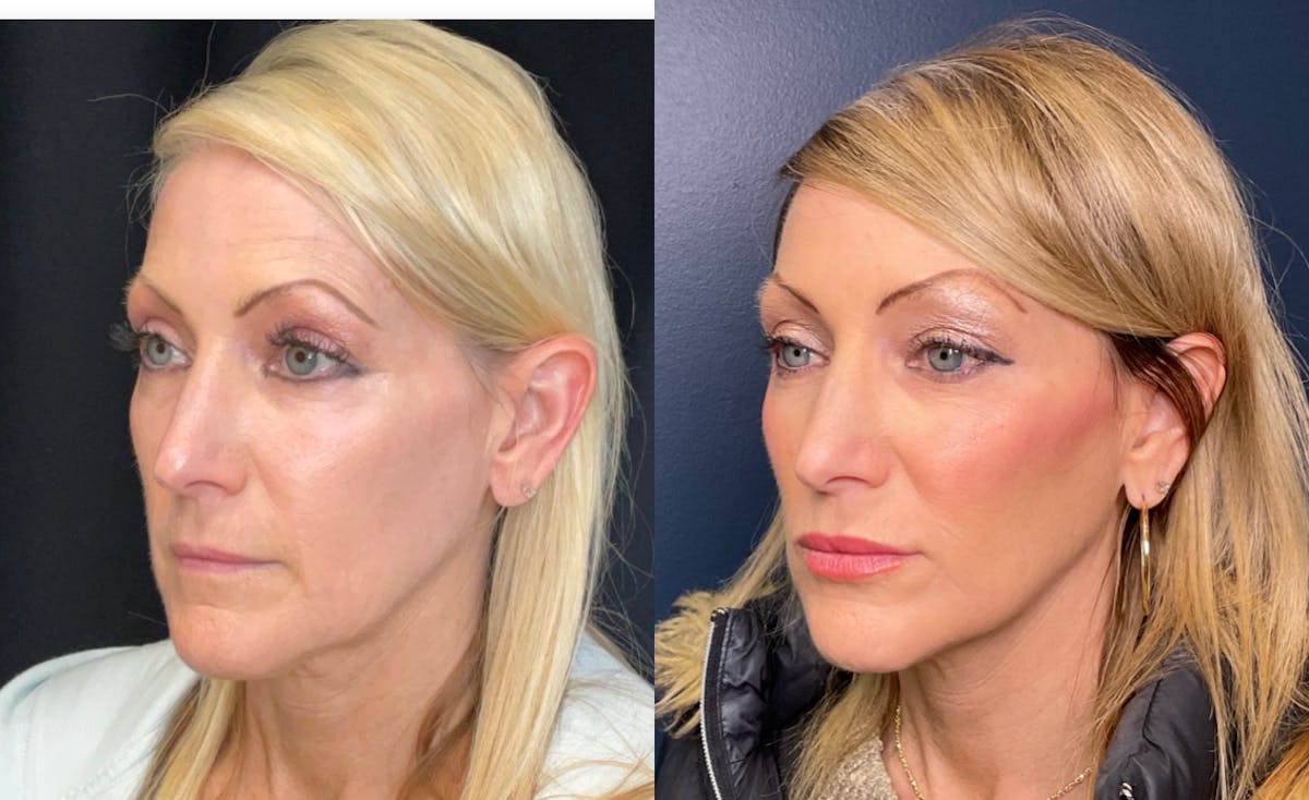 Sculptra Before & After Gallery - Patient 455043 - Image 3