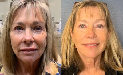 Sculptra Before & After Gallery - Patient 209444 - Image 1