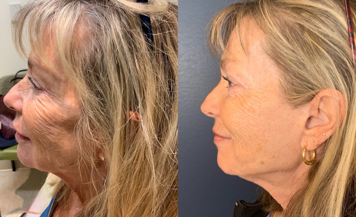 Sculptra Before & After Gallery - Patient 209444 - Image 2
