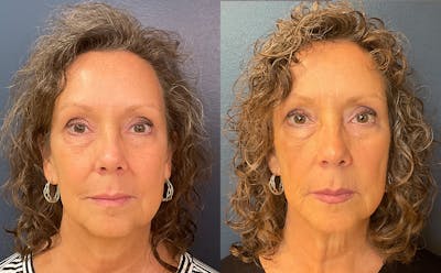 Restylane Before & After Gallery - Patient 246889 - Image 1