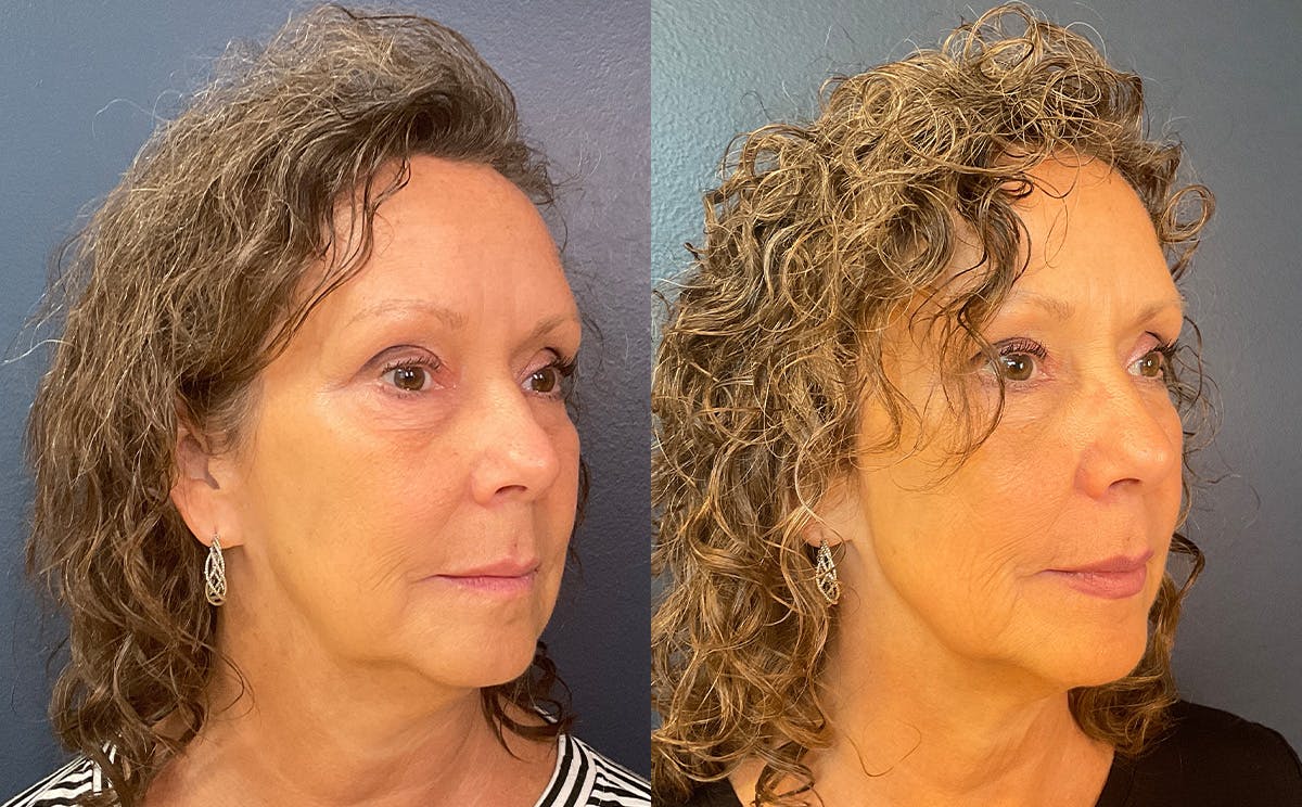 Restylane Before & After Gallery - Patient 246889 - Image 3