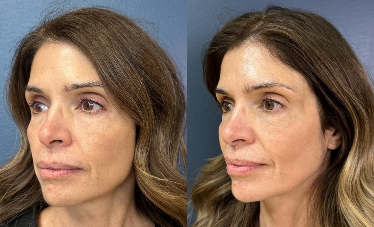 MOXI/BBL Laser Before & After Gallery - Patient 374666 - Image 2