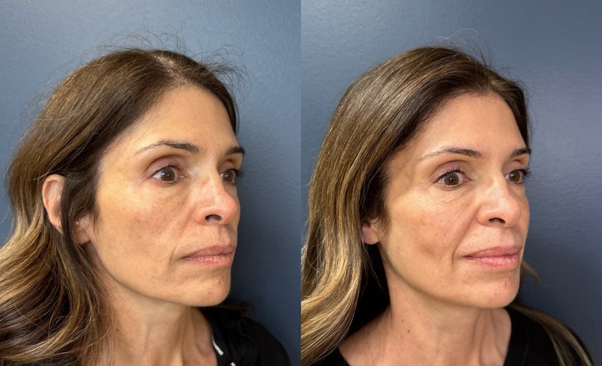 MOXI/BBL Laser Before & After Gallery - Patient 374666 - Image 3