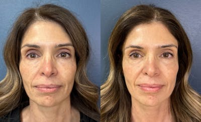 MOXI/BBL Laser Before & After Gallery - Patient 374666 - Image 1