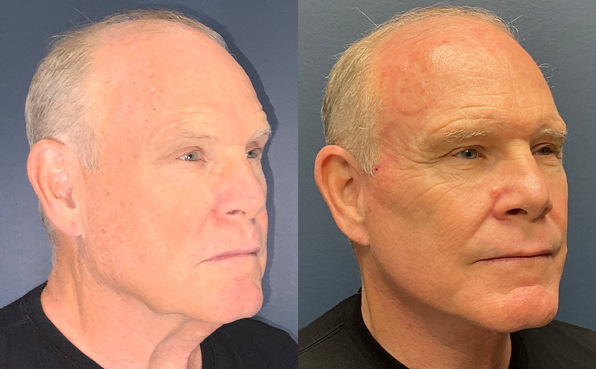 Patient 282358 | Face Lift Before & After Photos | Renaissance