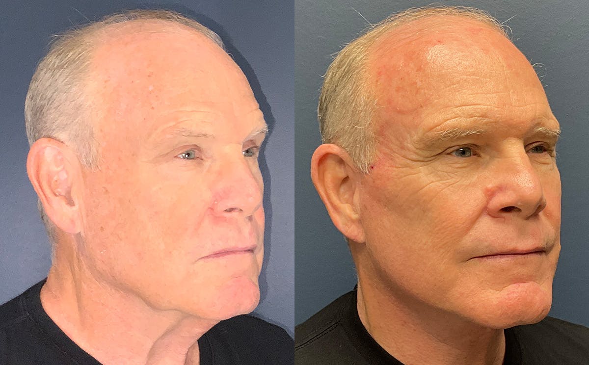 Face Lift Before & After Gallery - Patient 282358 - Image 2