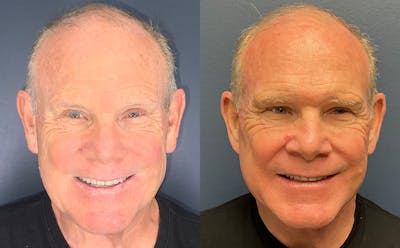 Face Lift Before & After Gallery - Patient 282358 - Image 1