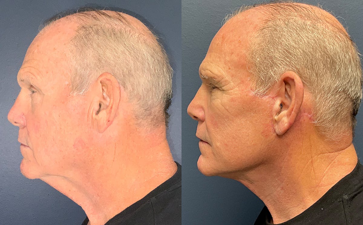 Face Lift Before & After Gallery - Patient 282358 - Image 3