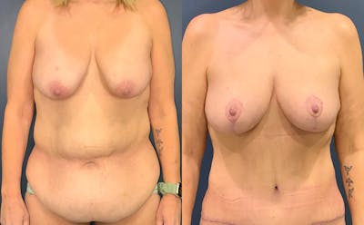 Tummy Tuck Before & After Gallery - Patient 328514 - Image 1