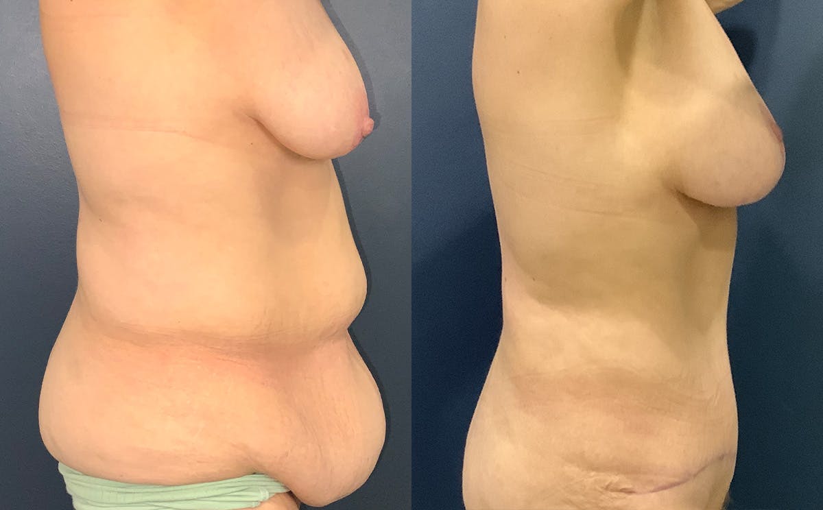 Tummy Tuck Before & After Gallery - Patient 328514 - Image 3
