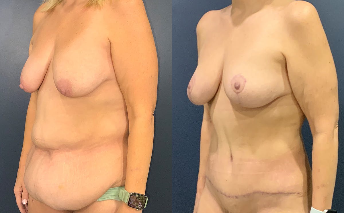 Tummy Tuck Before & After Gallery - Patient 328514 - Image 2