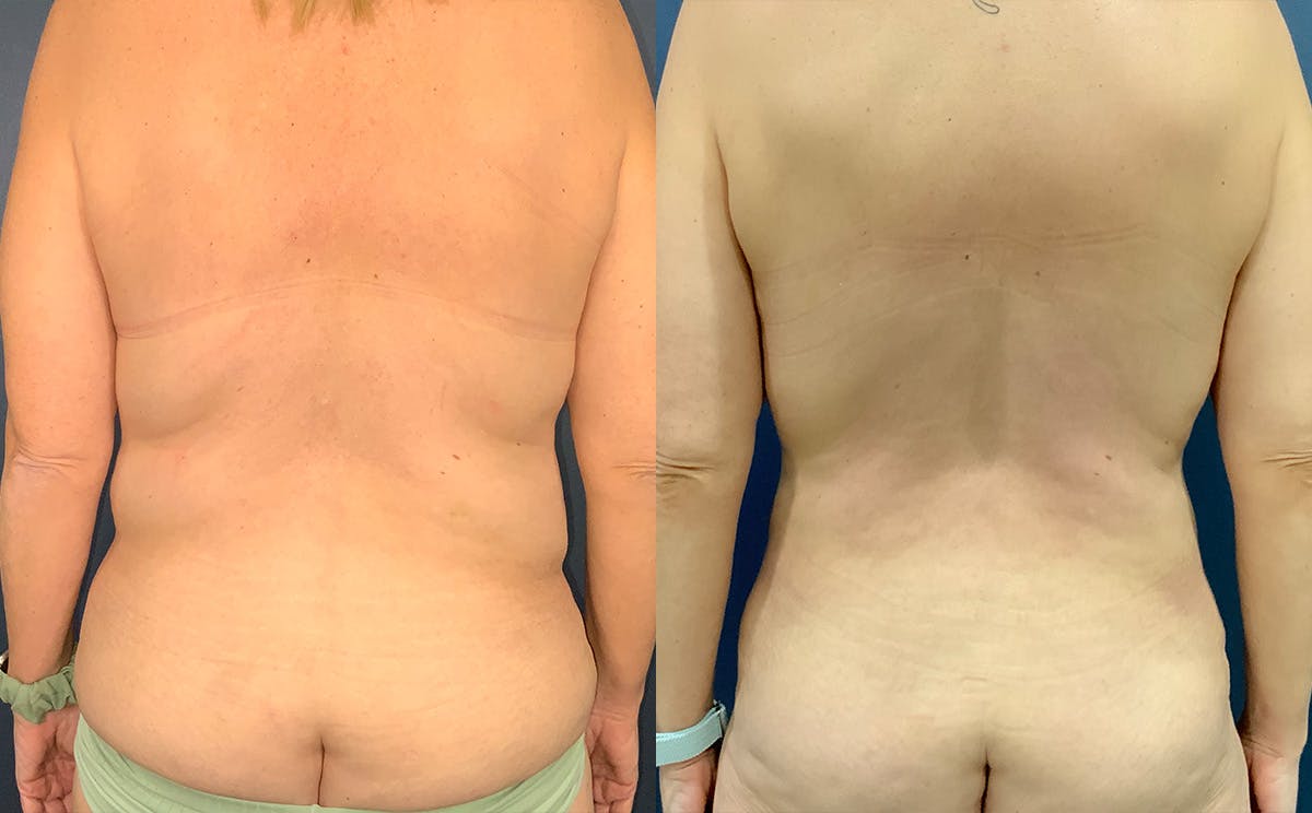 Tummy Tuck Before & After Gallery - Patient 328514 - Image 4