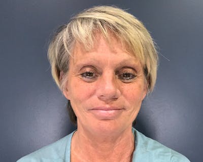 Mini Face Lift Before & After Gallery - Patient 106518 - Image 1