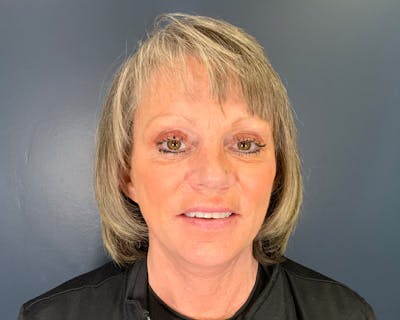 Mini Face Lift Before & After Gallery - Patient 106518 - Image 2