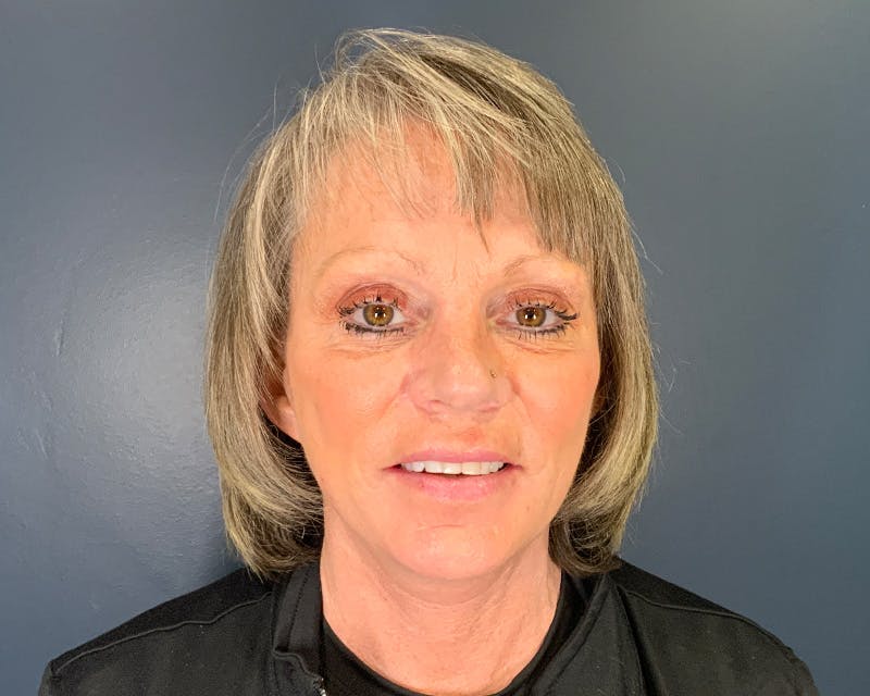 Mini Face Lift Before & After Gallery - Patient 106518 - Image 2