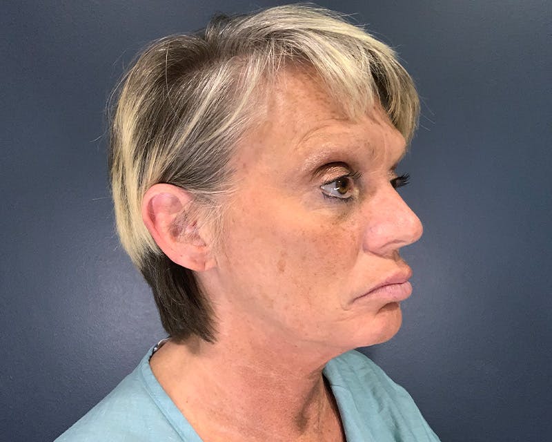 Mini Face Lift Before & After Gallery - Patient 106518 - Image 3