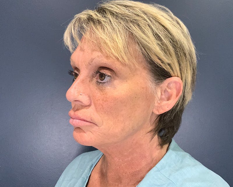 Mini Face Lift Before & After Gallery - Patient 106518 - Image 5