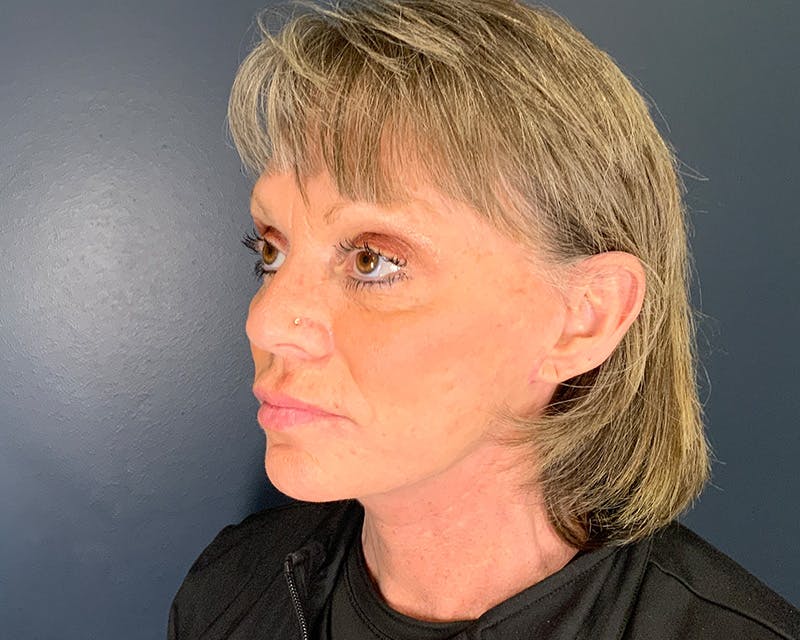 Mini Face Lift Before & After Gallery - Patient 106518 - Image 6