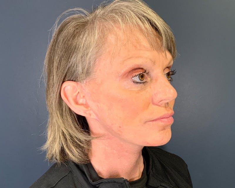 Mini Face Lift Before & After Gallery - Patient 106518 - Image 4