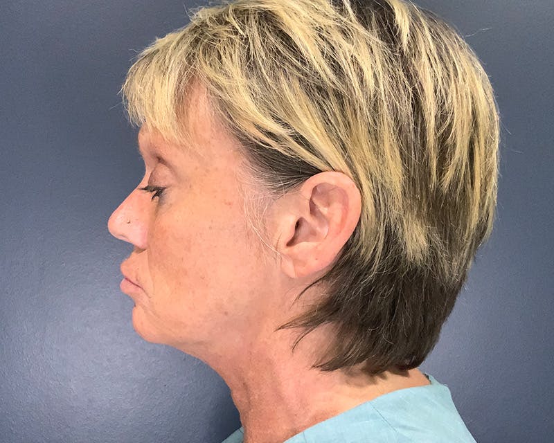 Mini Face Lift Before & After Gallery - Patient 106518 - Image 7