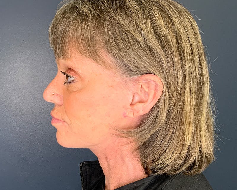 Mini Face Lift Before & After Gallery - Patient 106518 - Image 8