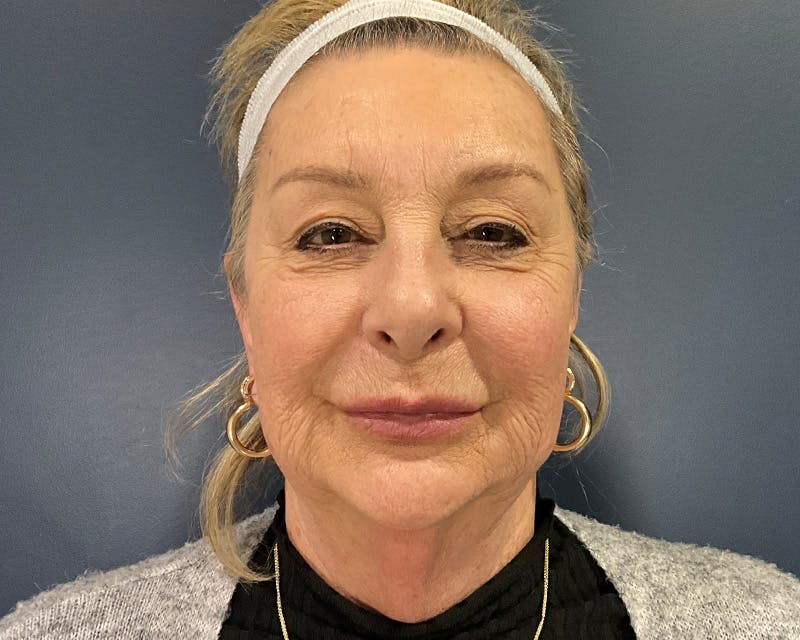 Face Lift Before & After Gallery - Patient 253417 - Image 1