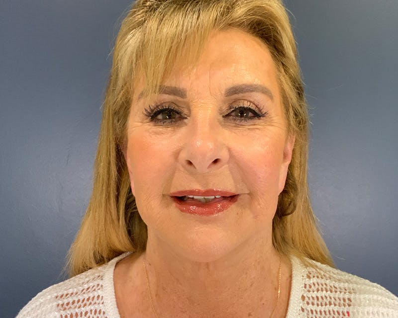Face Lift Before & After Gallery - Patient 253417 - Image 2