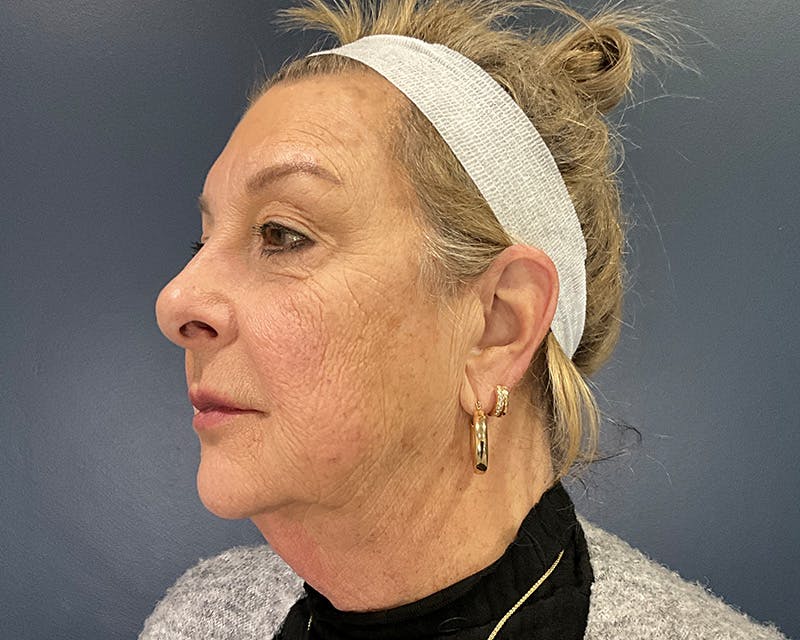 Face Lift Before & After Gallery - Patient 253417 - Image 3