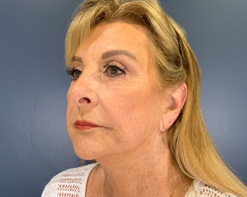 Face Lift Before & After Gallery - Patient 253417 - Image 4
