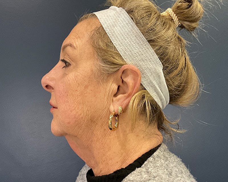 Face Lift Before & After Gallery - Patient 253417 - Image 5