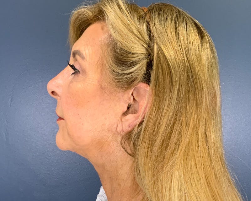 Face Lift Before & After Gallery - Patient 253417 - Image 6
