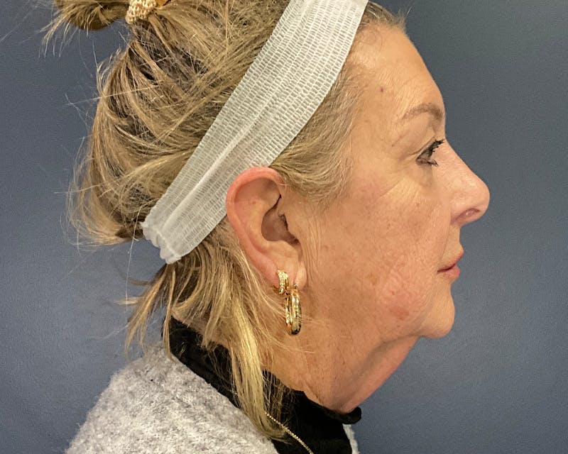 Face Lift Before & After Gallery - Patient 253417 - Image 7