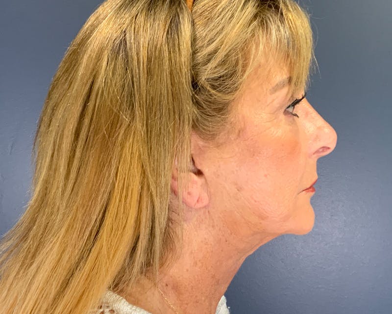 Face Lift Before & After Gallery - Patient 253417 - Image 8