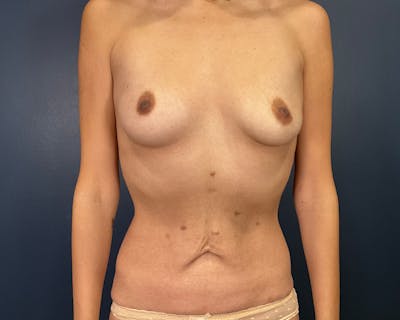 Breast Augmentation Before & After Gallery - Patient 867920 - Image 1