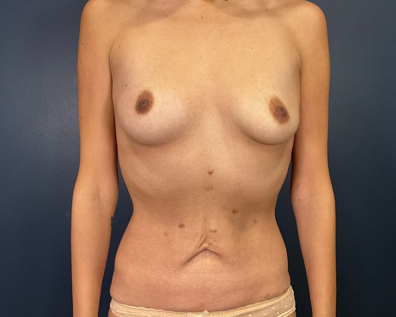 Tummy Tuck Before & After Gallery - Patient 122329 - Image 1