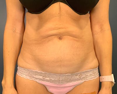 Tummy Tuck Before & After Gallery - Patient 952747 - Image 1