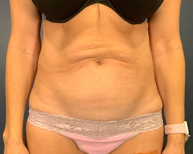 Tummy Tuck Before & After Gallery - Patient 952747 - Image 1