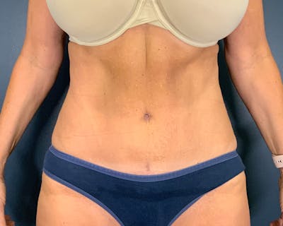 Tummy Tuck Before & After Gallery - Patient 952747 - Image 2