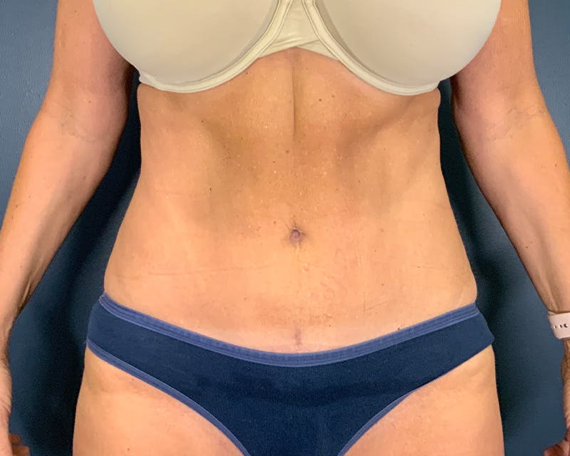 Tummy Tuck Before & After Gallery - Patient 952747 - Image 2