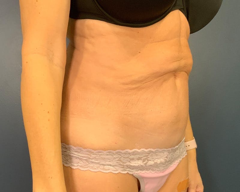 Tummy Tuck Before & After Gallery - Patient 952747 - Image 3