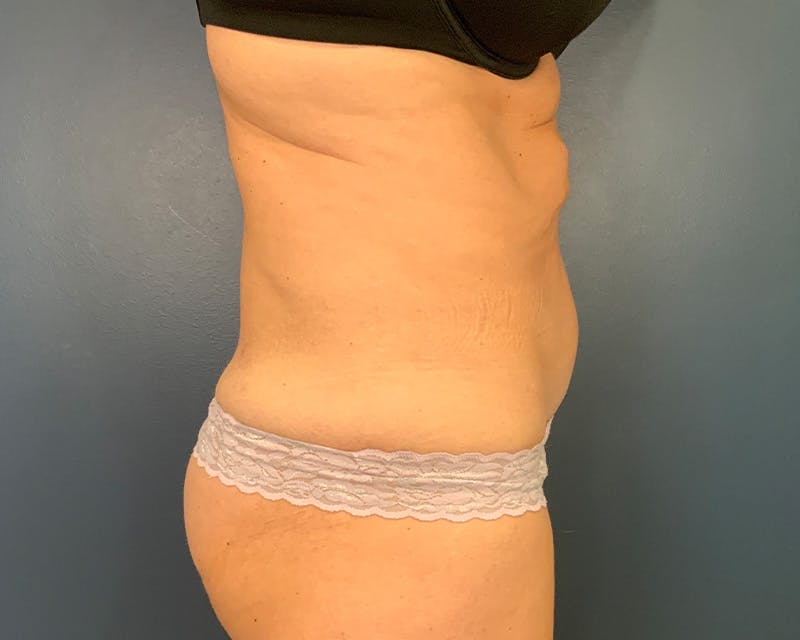 Tummy Tuck Before & After Gallery - Patient 952747 - Image 5