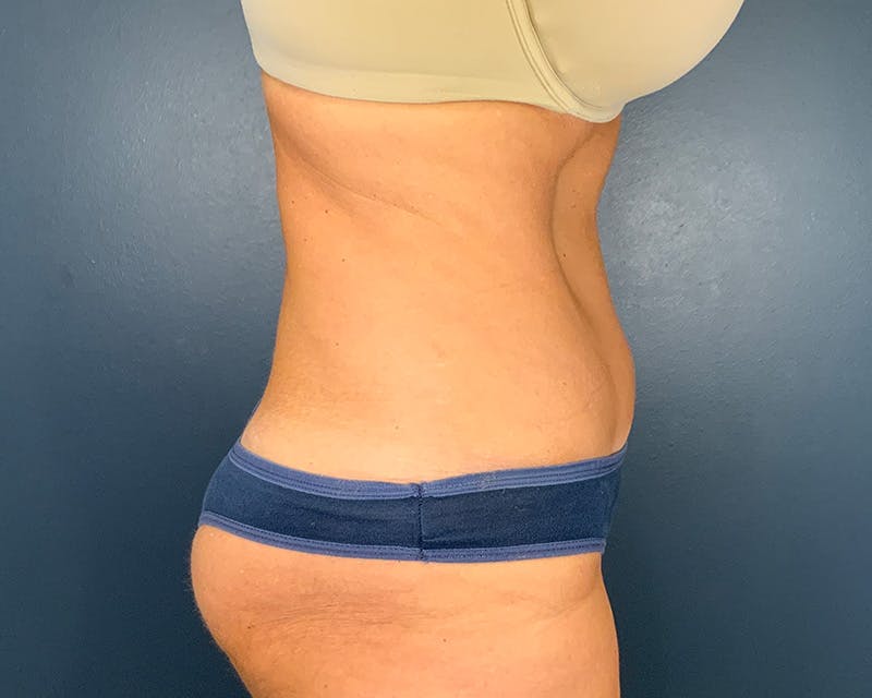 Tummy Tuck Before & After Gallery - Patient 952747 - Image 6
