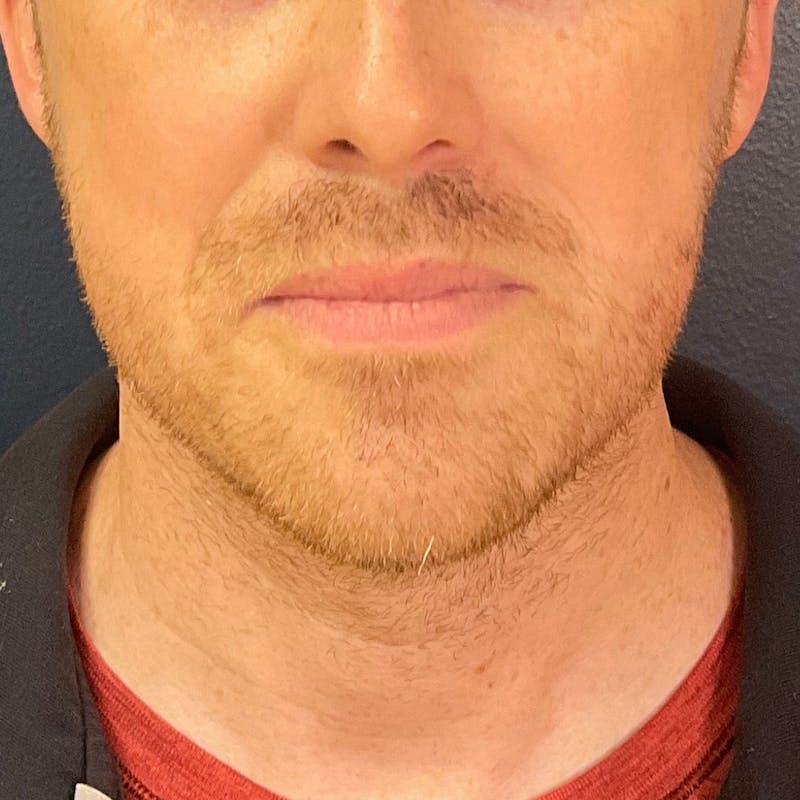 Dermal Filler Before & After Gallery - Patient 812195 - Image 2