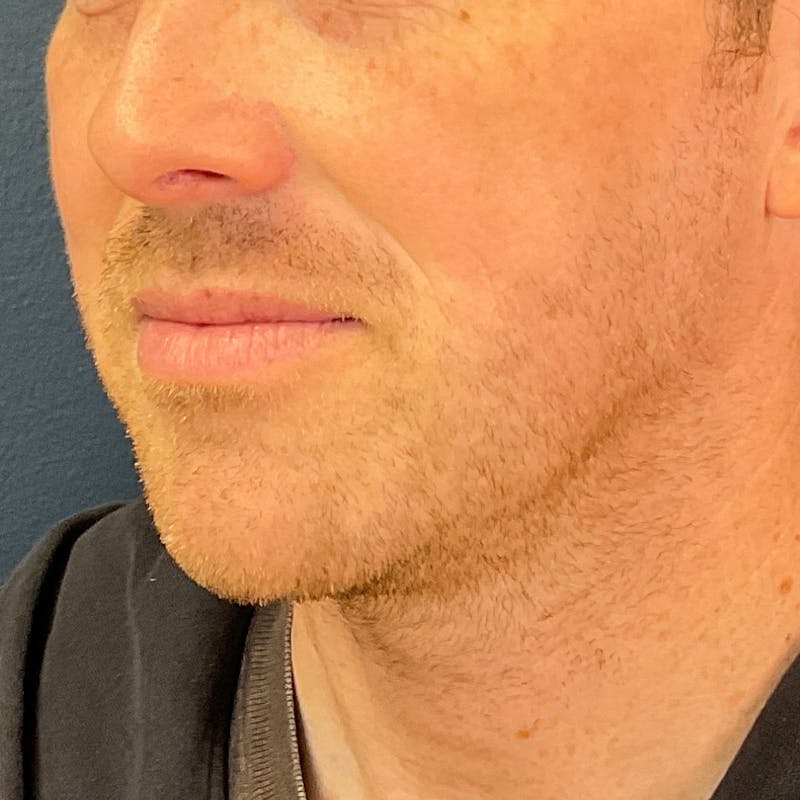 Dermal Filler Before & After Gallery - Patient 812195 - Image 3