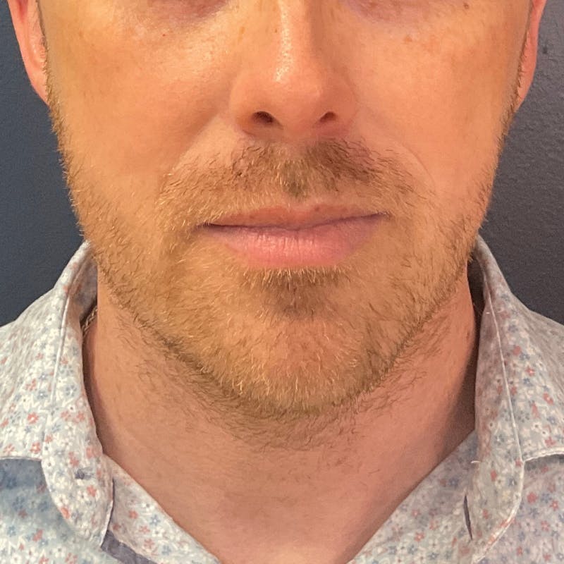 Dermal Filler Before & After Gallery - Patient 812195 - Image 1
