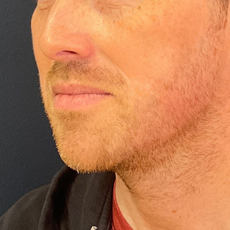 Dermal Filler Before & After Gallery - Patient 812195 - Image 4