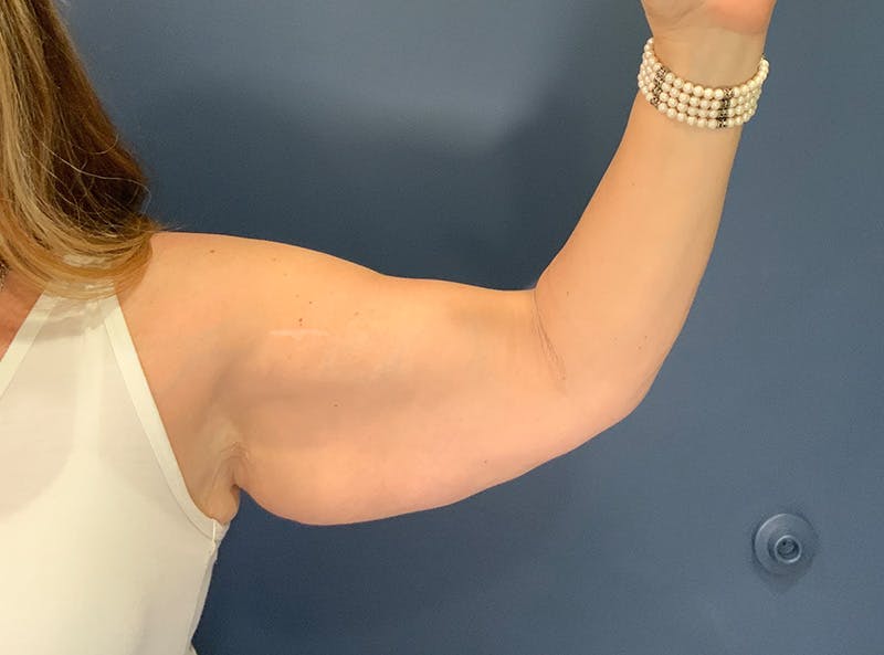 Liposuction Before & After Gallery - Patient 153853 - Image 7