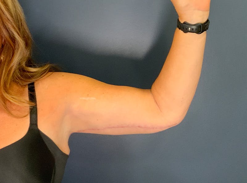 Liposuction Before & After Gallery - Patient 153853 - Image 8