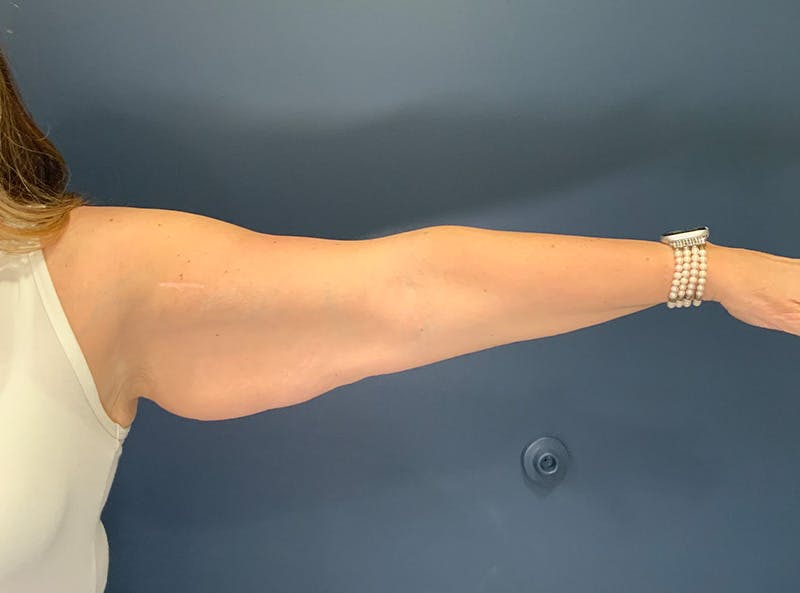 Liposuction Before & After Gallery - Patient 153853 - Image 1